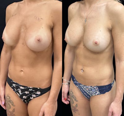 Breast Revision Surgery Before & After Gallery - Patient 417759 - Image 2