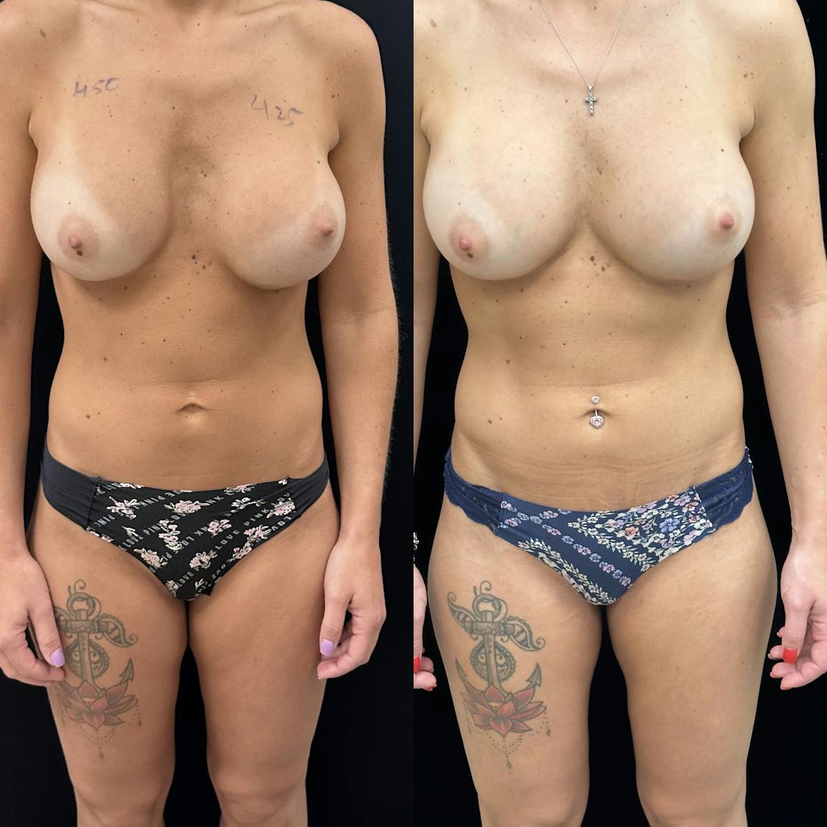 Breast Revision Surgery Before & After Gallery - Patient 417759 - Image 1