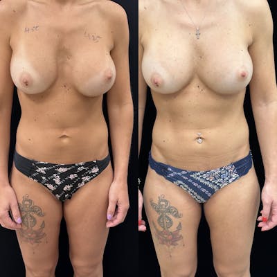 Breast Revision Surgery Before & After Gallery - Patient 417759 - Image 1