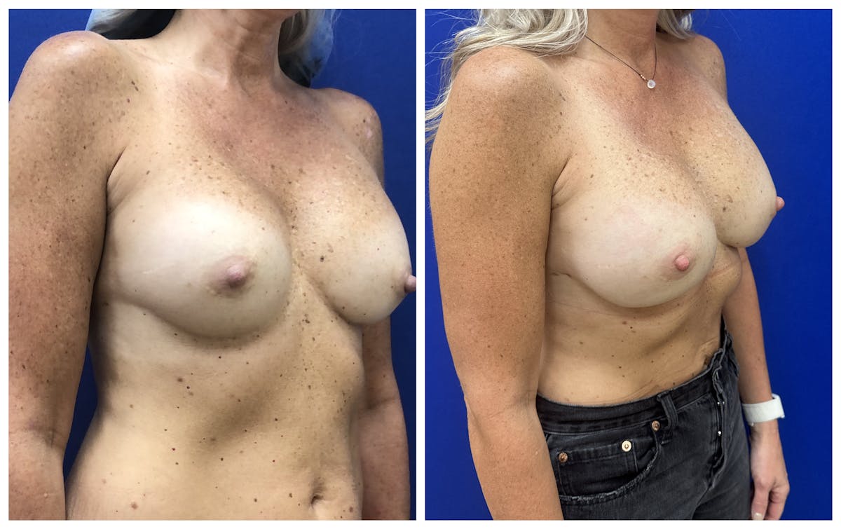  Breast Revision Surgery Before & After Gallery - Patient 168026 - Image 2