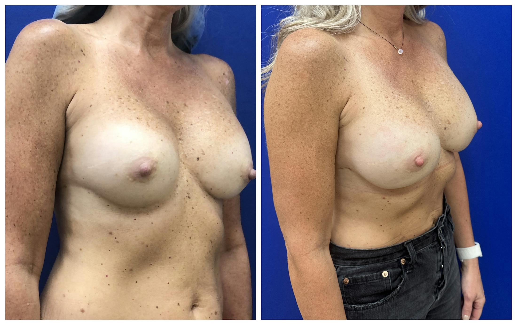  Breast Revision Surgery Before & After Gallery - Patient 168026 - Image 2