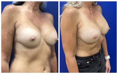 Breast Revision Surgery Before & After Gallery - Patient 168026 - Image 2