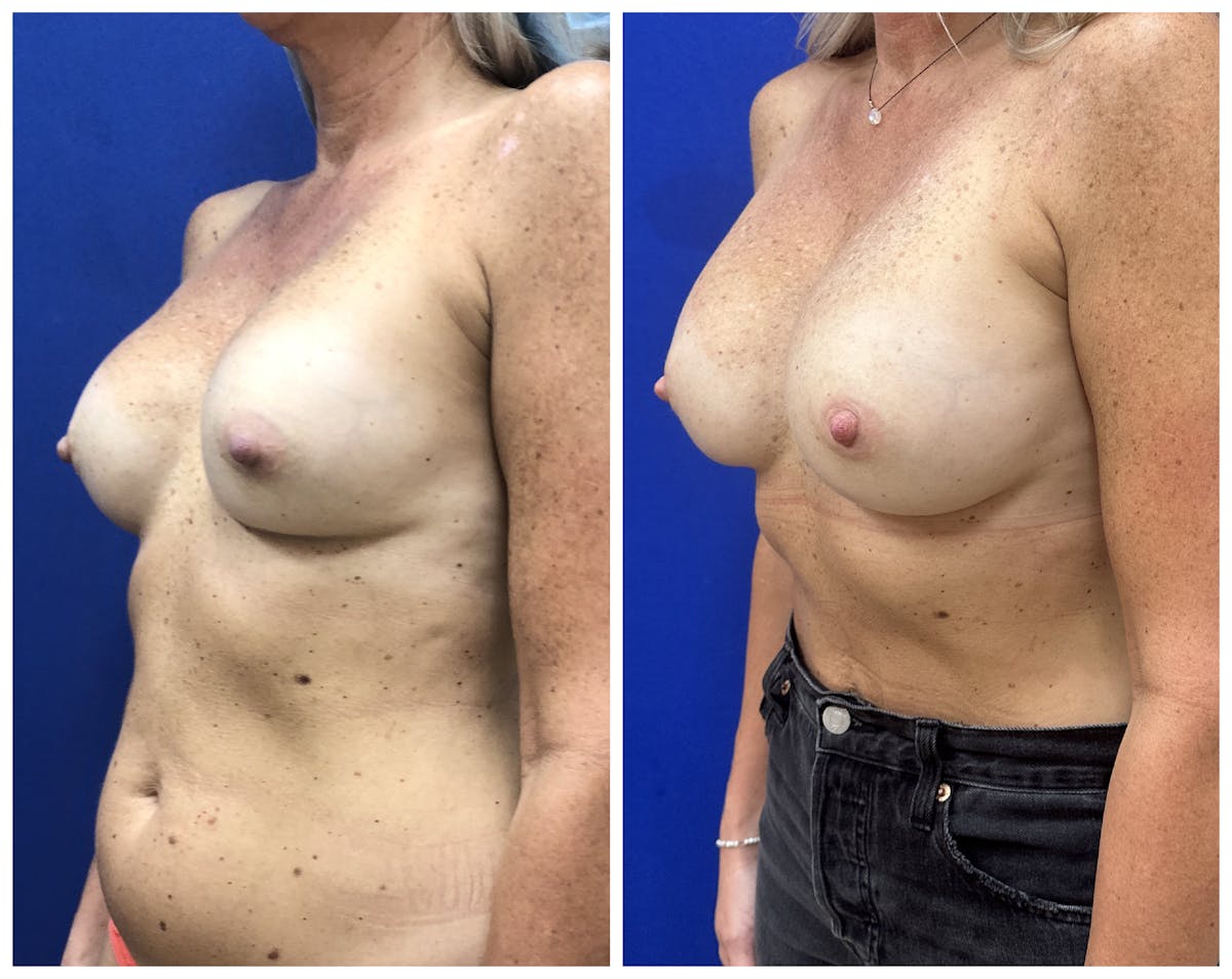  Breast Revision Surgery Before & After Gallery - Patient 168026 - Image 3