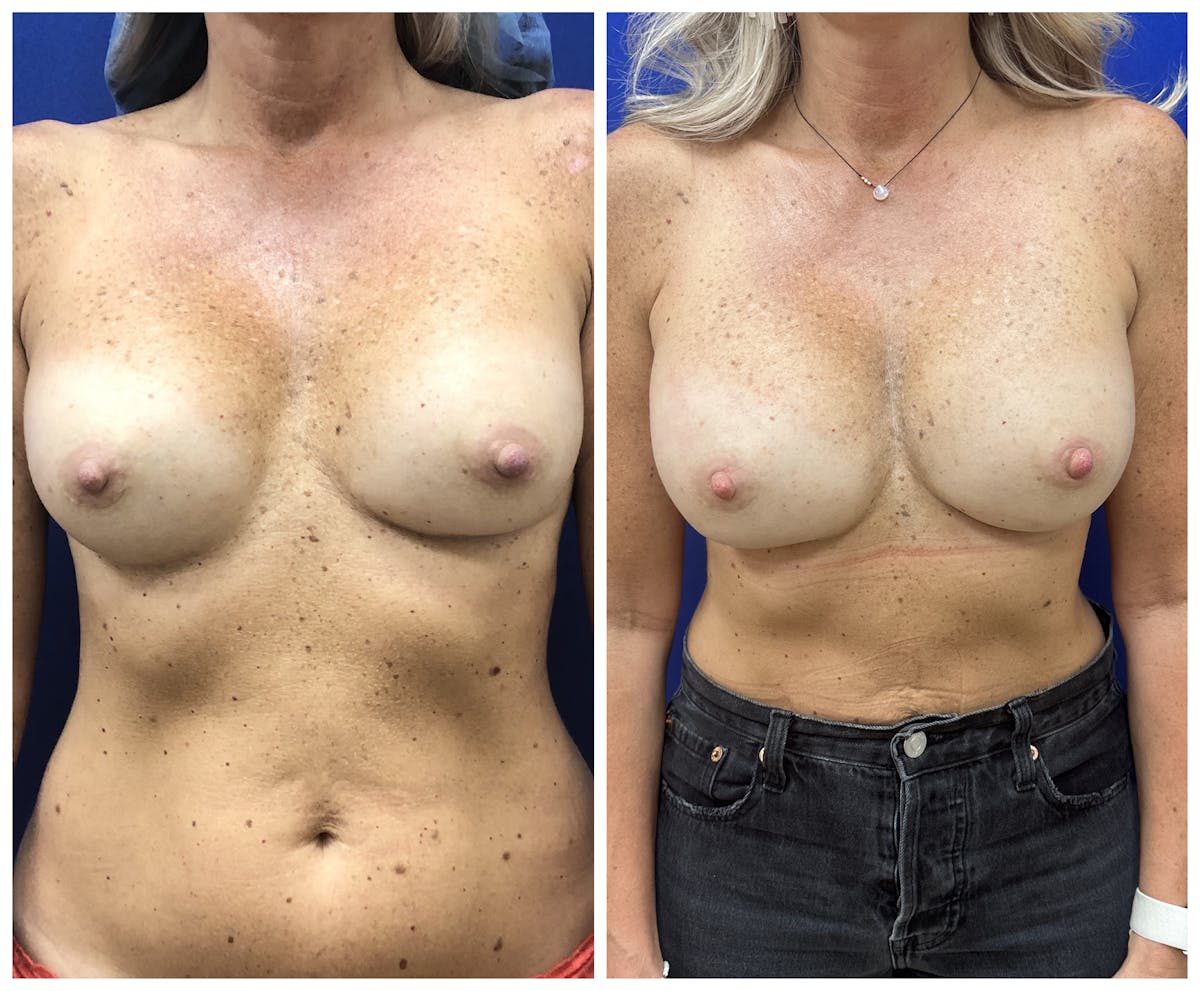  Breast Revision Surgery Before & After Gallery - Patient 168026 - Image 1