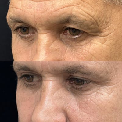 Upper Blepharoplasty Before & After Gallery - Patient 107912 - Image 3