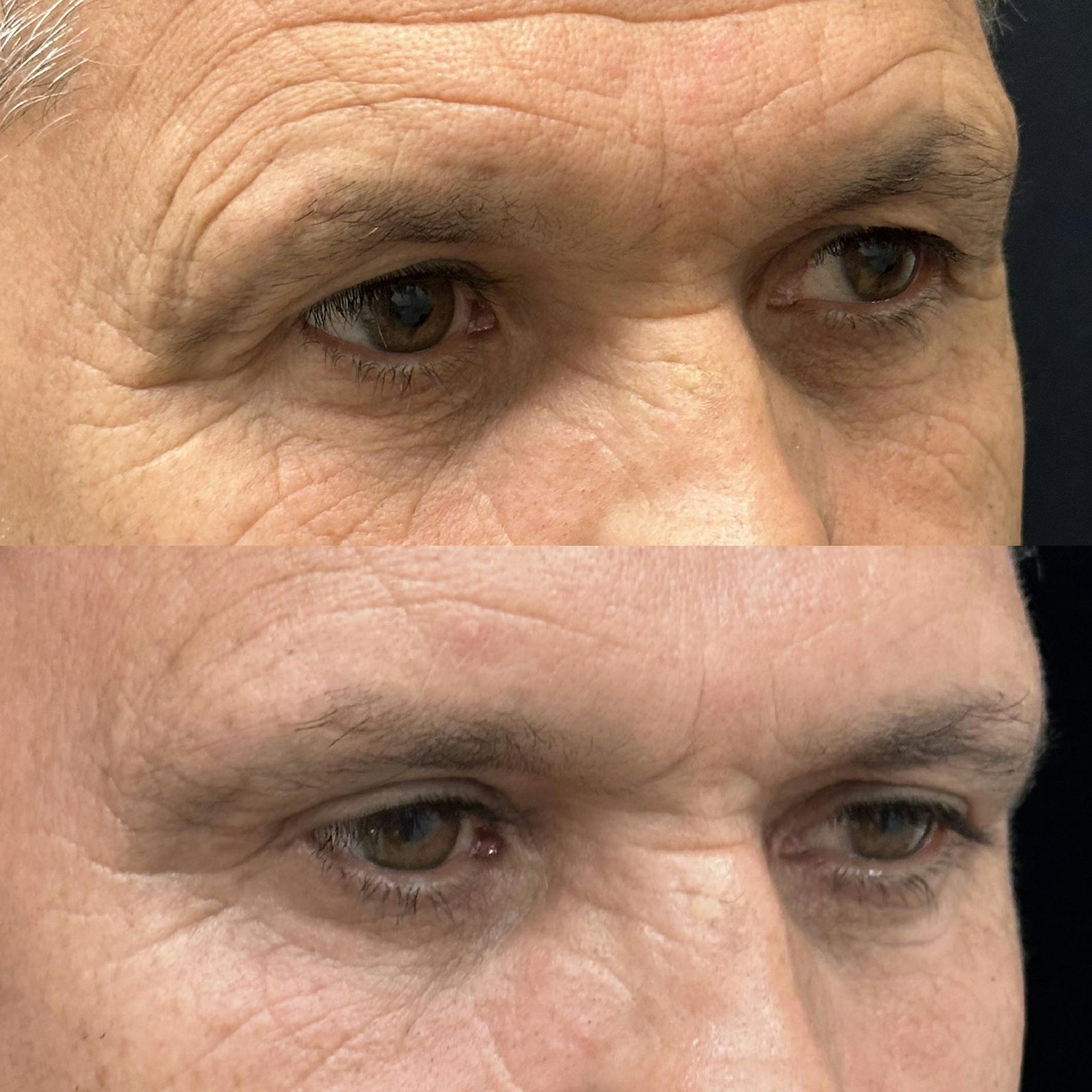  Upper Blepharoplasty Before & After Gallery - Patient 107912 - Image 2