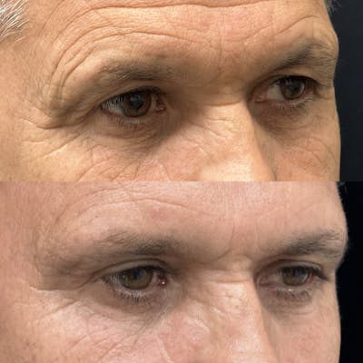 Upper Blepharoplasty Before & After Gallery - Patient 107912 - Image 2