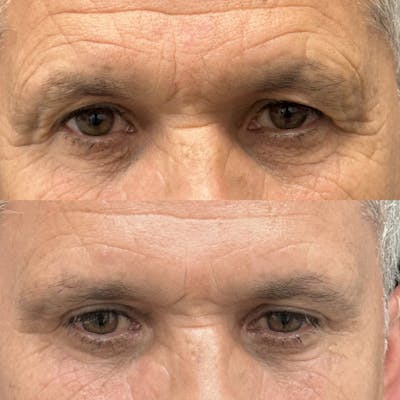 Upper Blepharoplasty Before & After Gallery - Patient 107912 - Image 1