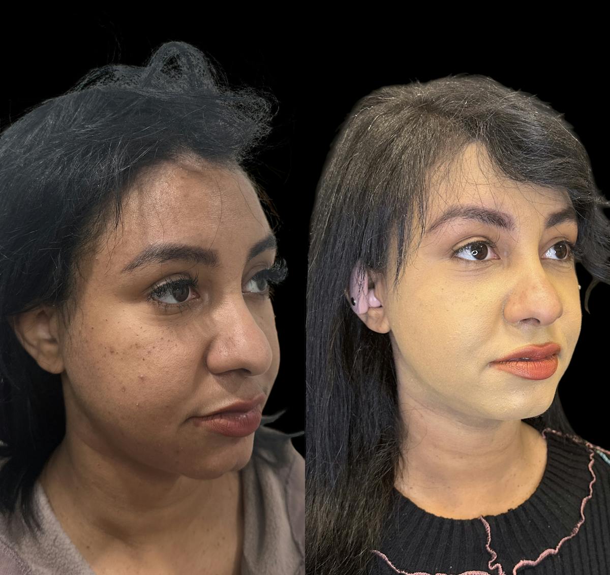 Buccal Fat Reduction Before & After Gallery - Patient 151367 - Image 2