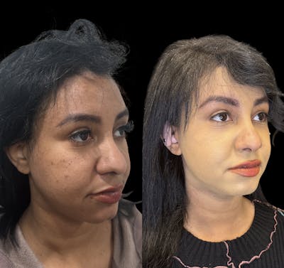 Buccal Fat Reduction Before & After Gallery - Patient 151367 - Image 2