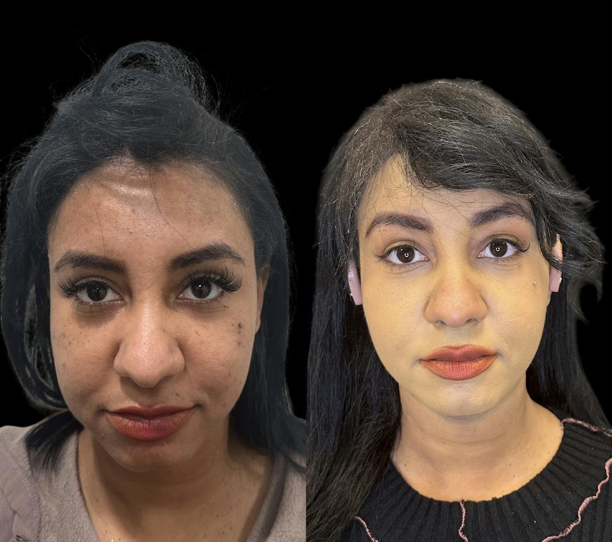 Buccal Fat Reduction Before & After Gallery - Patient 151367 - Image 1