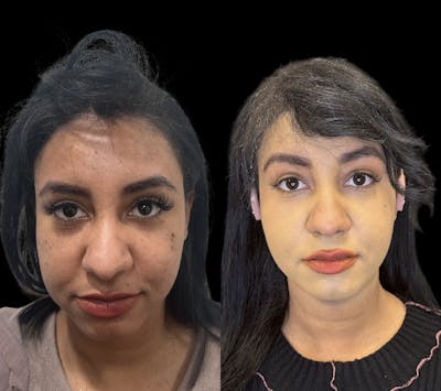 Buccal Fat Reduction Before & After Gallery - Patient 151367 - Image 1