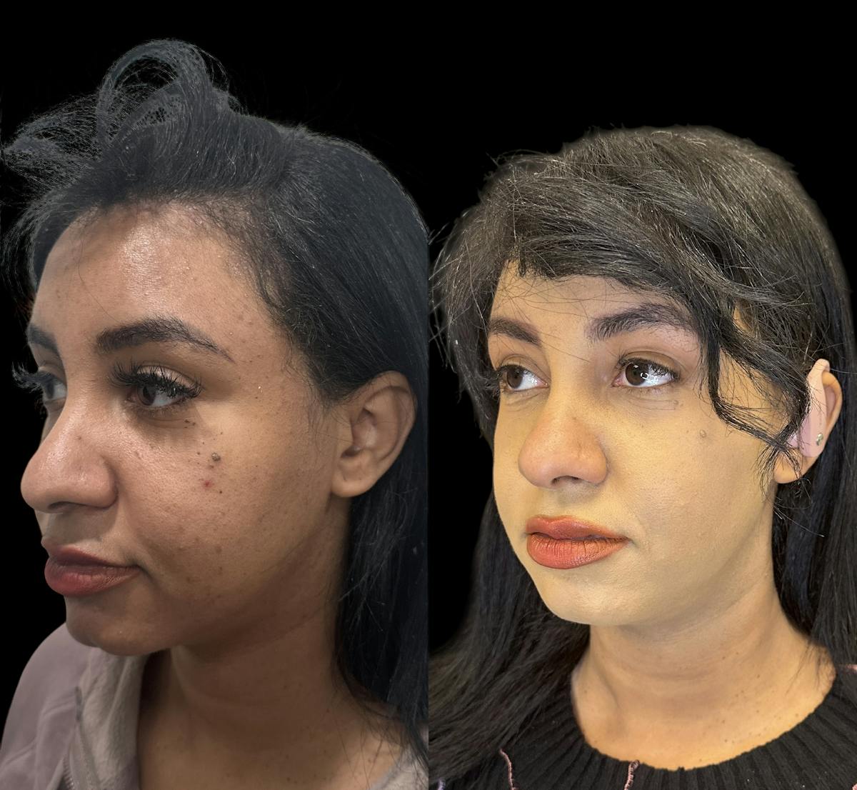 Buccal Fat Reduction Before & After Gallery - Patient 151367 - Image 3