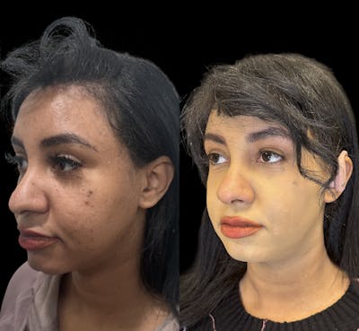 Buccal Fat Reduction Before & After Gallery - Patient 151367 - Image 3