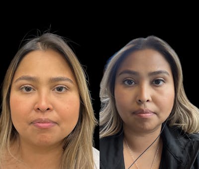 Buccal Fat Reduction Before & After Gallery - Patient 255420 - Image 1