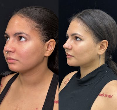 Chin Implant Before & After Gallery - Patient 361910 - Image 4