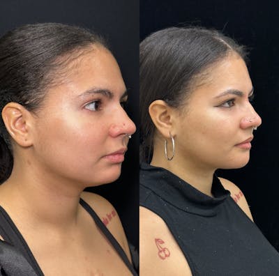 Chin Implant Before & After Gallery - Patient 361910 - Image 2