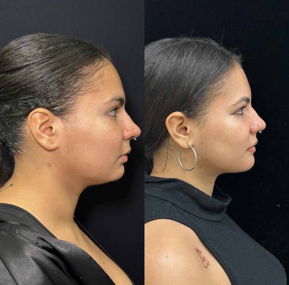 Chin Implant Before & After Gallery - Patient 361910 - Image 1