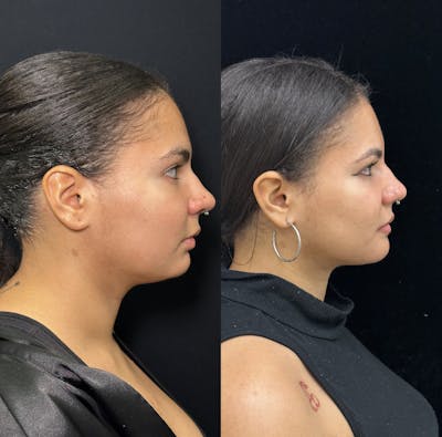 Chin Implant Before & After Gallery - Patient 361910 - Image 1