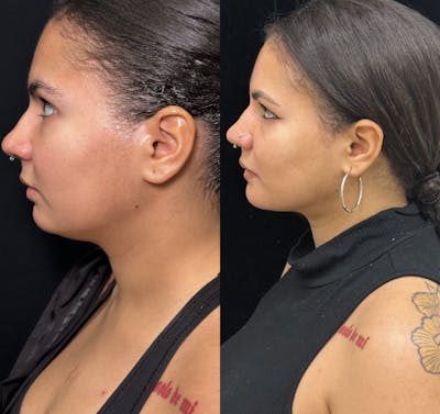 Chin Implant Before & After Gallery - Patient 361910 - Image 3