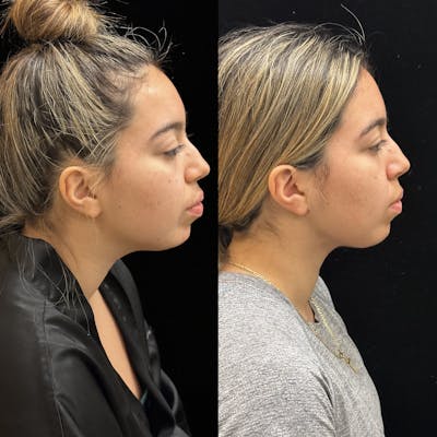 Chin & Neck Lipo Sculpting Before & After Gallery - Patient 275560 - Image 1