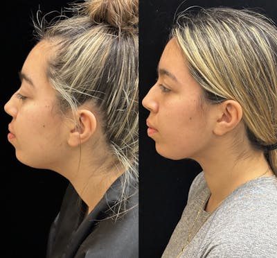 Chin & Neck Lipo Sculpting Before & After Gallery - Patient 275560 - Image 4