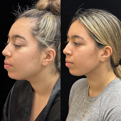 Chin & Neck Lipo Sculpting Before & After Gallery - Patient 275560 - Image 3