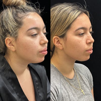 Chin & Neck Lipo Sculpting Before & After Gallery - Patient 275560 - Image 2