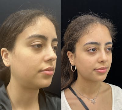 Chin & Neck Lipo Sculpting Before & After Gallery - Patient 224327 - Image 2