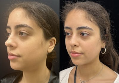 Chin & Neck Lipo Sculpting Before & After Gallery - Patient 224327 - Image 4
