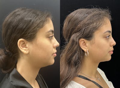 Chin & Neck Lipo Sculpting Before & After Gallery - Patient 224327 - Image 1