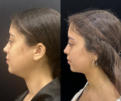 Chin & Neck Lipo Sculpting Before & After Gallery - Patient 224327 - Image 3