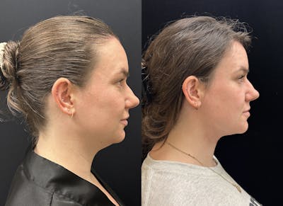 Chin & Neck Lipo Sculpting Before & After Gallery - Patient 238272 - Image 1