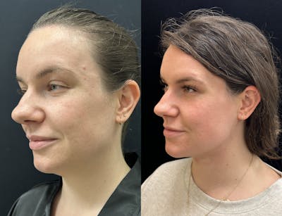 Chin & Neck Lipo Sculpting Before & After Gallery - Patient 238272 - Image 3