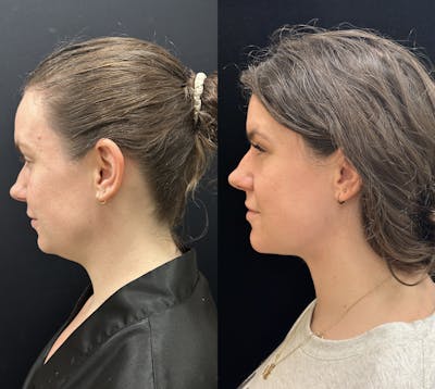 Chin & Neck Lipo Sculpting Before & After Gallery - Patient 238272 - Image 2