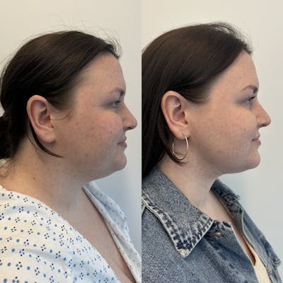 Chin & Neck Lipo Sculpting Before & After Gallery - Patient 375924 - Image 1