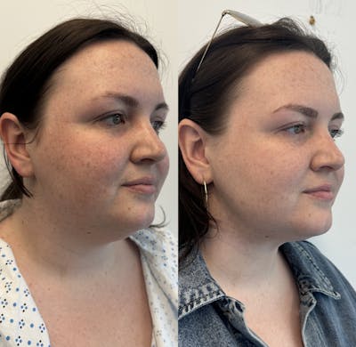 Chin & Neck Lipo Sculpting Before & After Gallery - Patient 375924 - Image 2