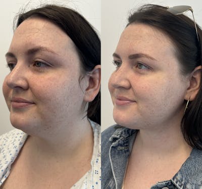 Chin & Neck Lipo Sculpting Before & After Gallery - Patient 375924 - Image 3
