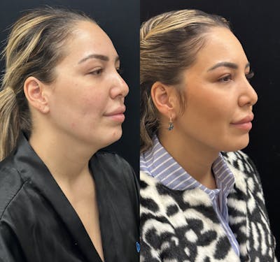 Chin & Neck Lipo Sculpting Before & After Gallery - Patient 226896 - Image 2
