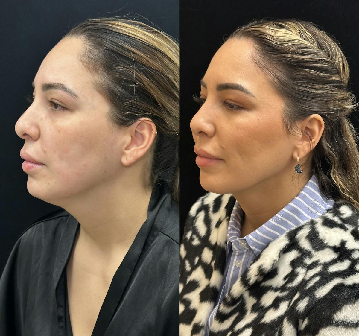 Chin & Neck Lipo Sculpting Before & After Gallery - Patient 226896 - Image 4