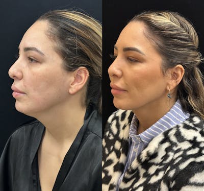 Chin & Neck Lipo Sculpting Before & After Gallery - Patient 226896 - Image 4