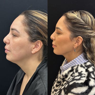 Chin & Neck Lipo Sculpting Before & After Gallery - Patient 226896 - Image 3