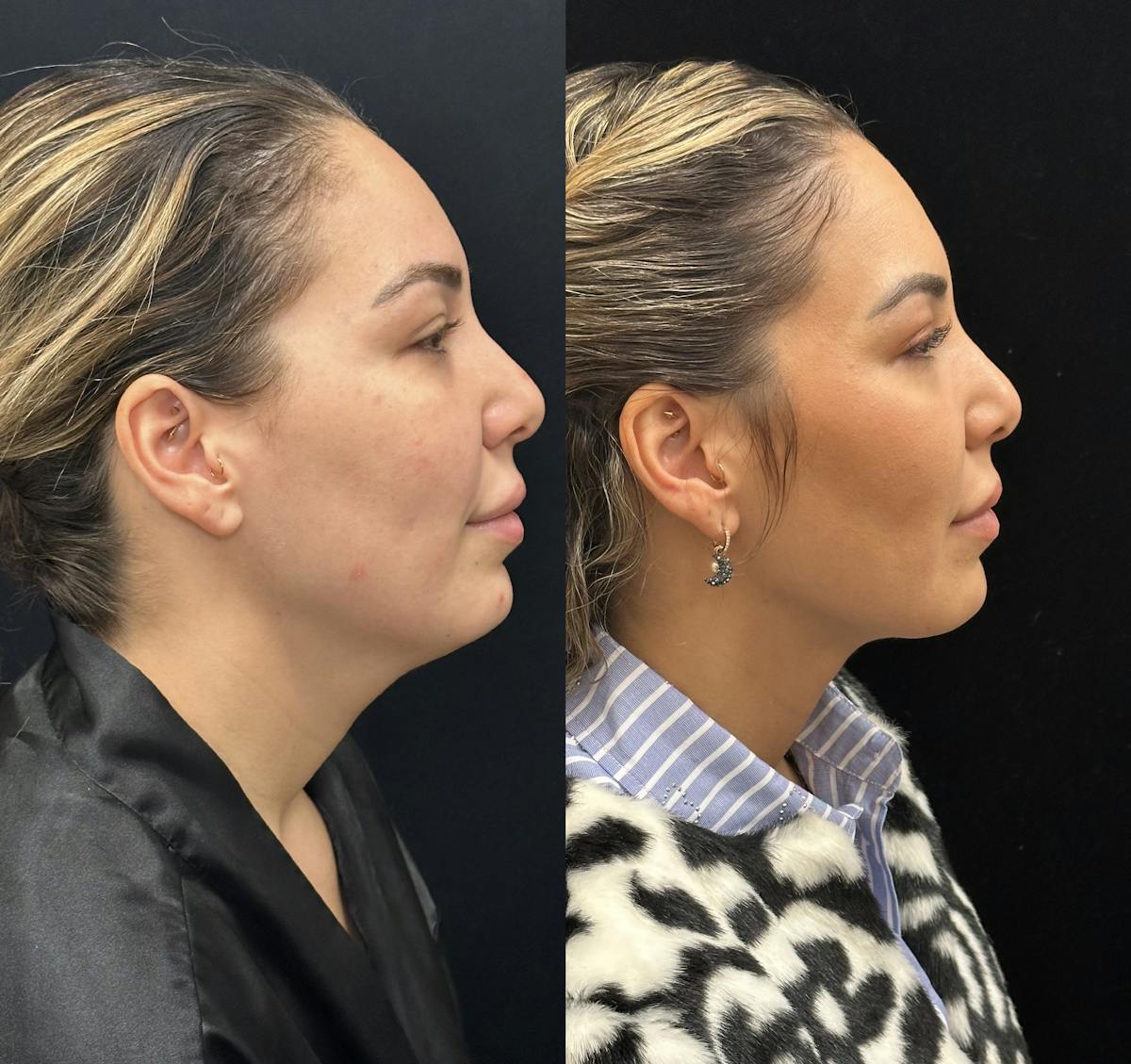 Chin & Neck Lipo Sculpting Before & After Gallery - Patient 226896 - Image 1