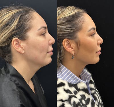 Chin & Neck Lipo Sculpting Before & After Gallery - Patient 226896 - Image 1