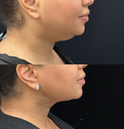 Buccal Fat Reduction Before & After Gallery - Patient 129726 - Image 2