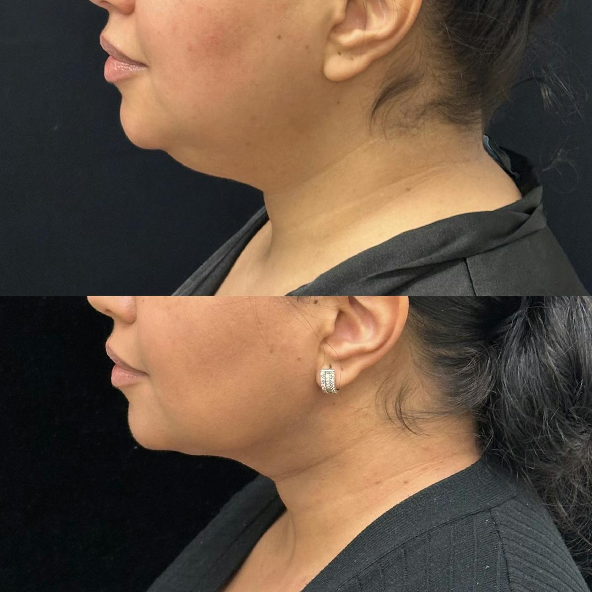 Chin & Neck Lipo Sculpting Before & After Gallery - Patient 288456 - Image 3