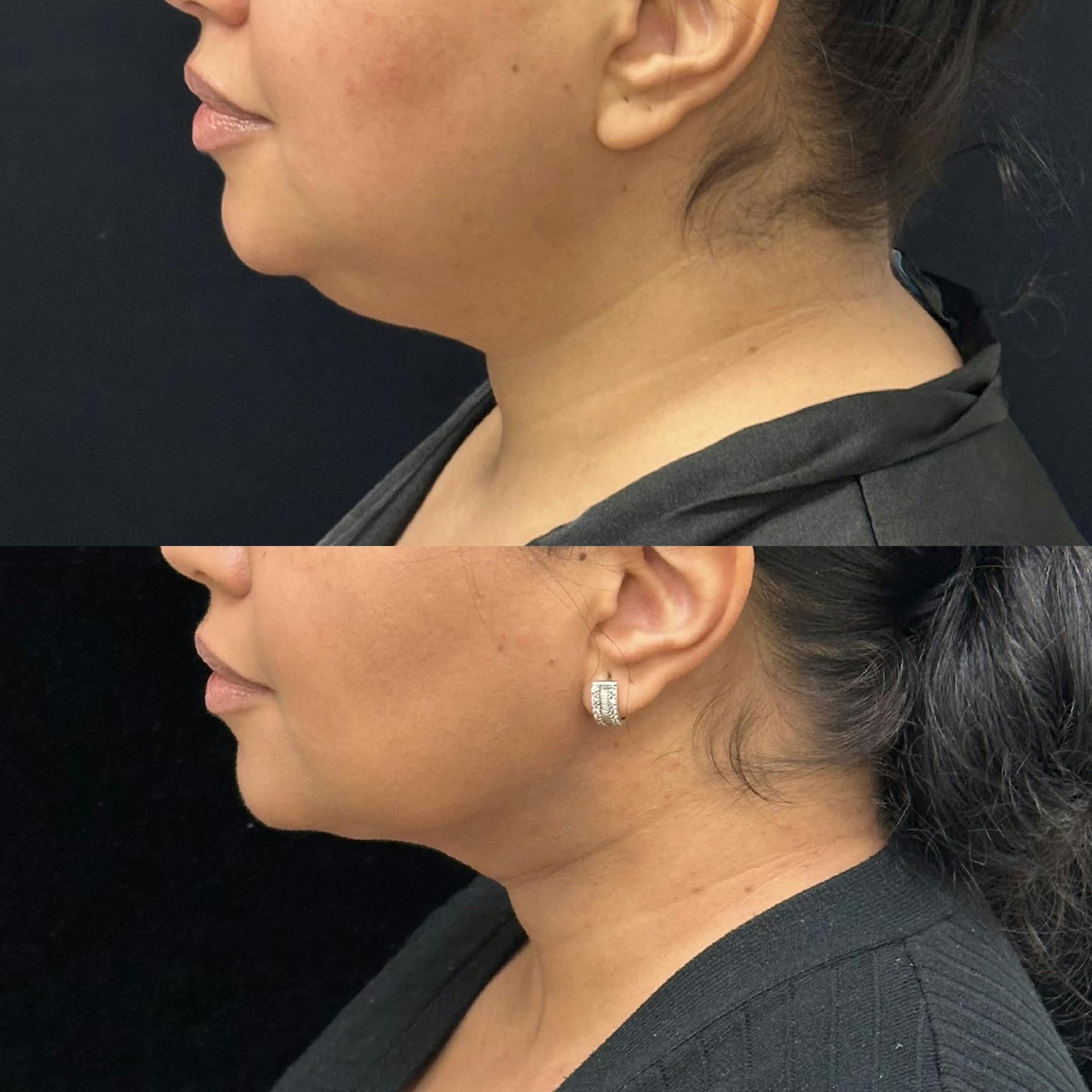 Chin & Neck Lipo Sculpting Before & After Gallery - Patient 288456 - Image 3