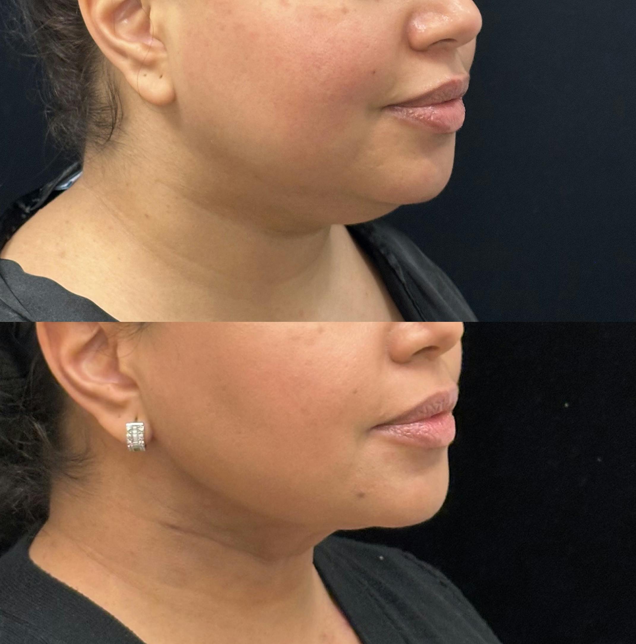 Chin & Neck Lipo Sculpting Before & After Gallery - Patient 288456 - Image 2