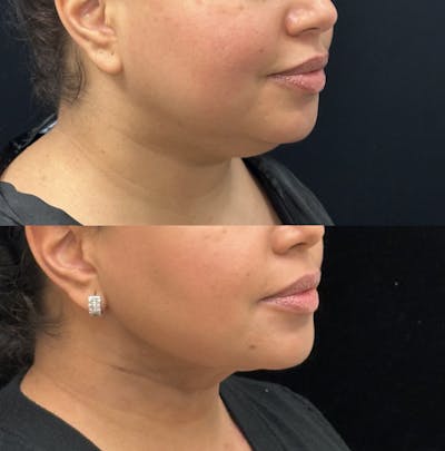 Facial Slimming Surgery Before & After Gallery - Patient 133536 - Image 1