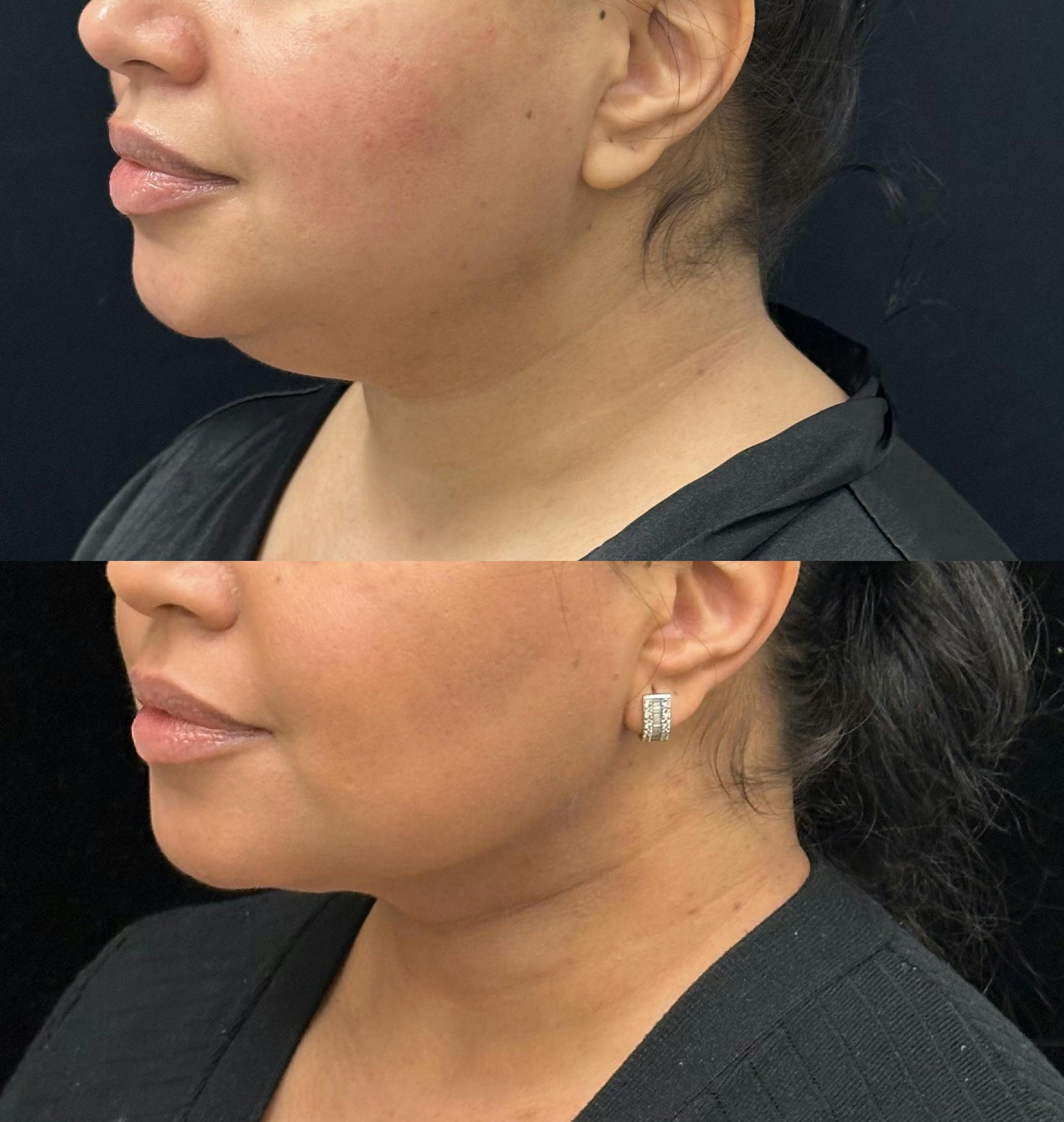 Chin & Neck Lipo Sculpting Before & After Gallery - Patient 288456 - Image 4
